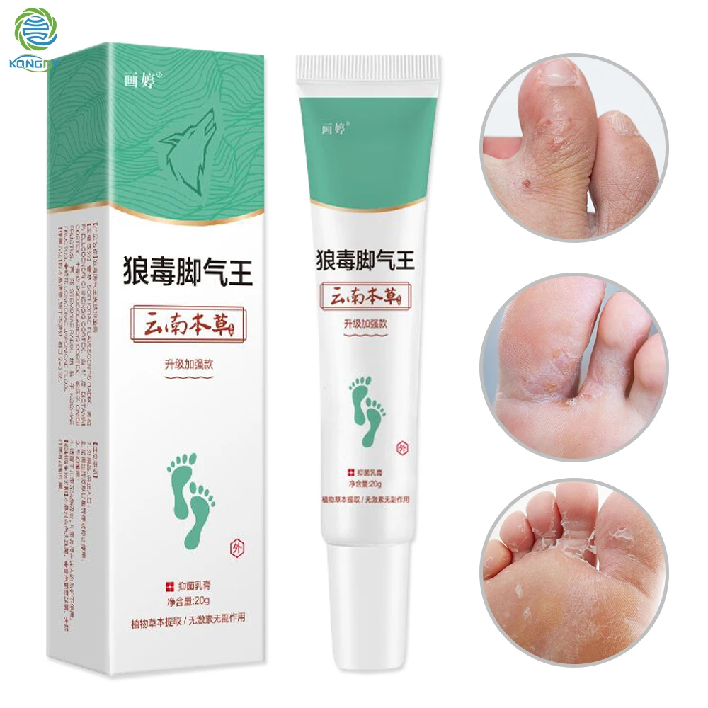 

KONGDY 1 коробка крем для ног берибери крем для ног от грибковой инфекции крем для ног 20 г крем для ног спортсменов Китайский травяной Антибакте...