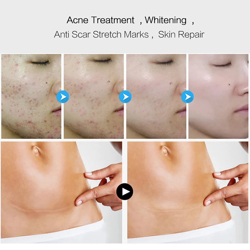 

1 Pcs Facial Essence 15ml Face Skin Care Scar Acne Removal Moisturizing Anti Wrinkle MH88