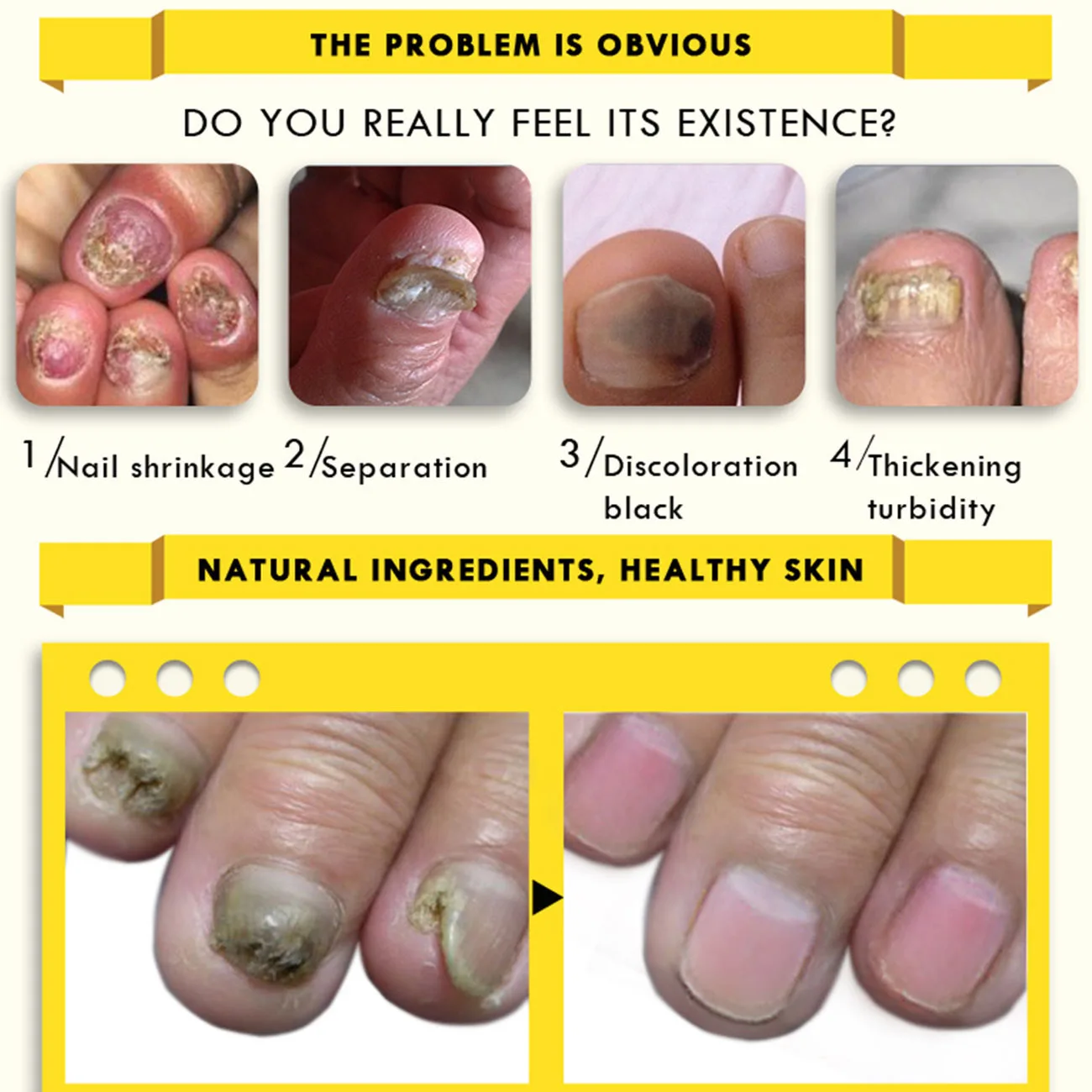 

OEDO Nail Treatment Serum Onychomycosis Paronychia Anti-Fungal Nail Infection Herbal Toe Foot Repair Essence Care