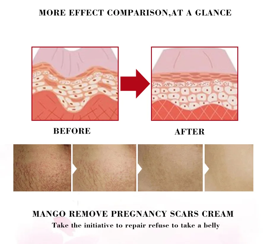 Remove Pregnancy Acne Scar Stretch Mark Cream Treatment Maternal Anti-aging Repair Anti-wrinkle Firming Body | Красота и здоровье