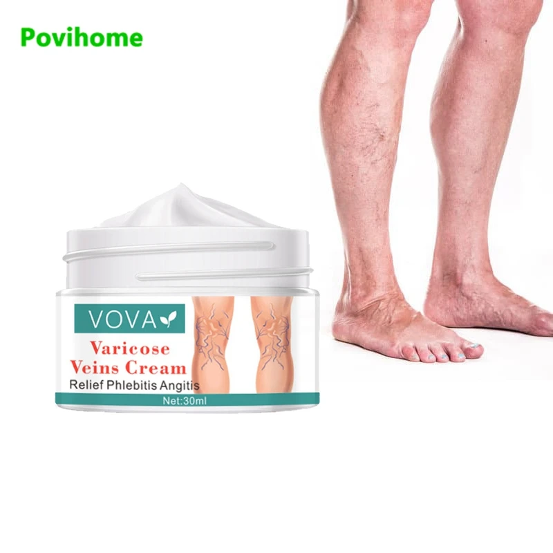 

30ml Treatment Varicose Veins Cream Varicosity Angiitis Ointment Relief Veins Pain Phlebitis Medical Plaster Health Care