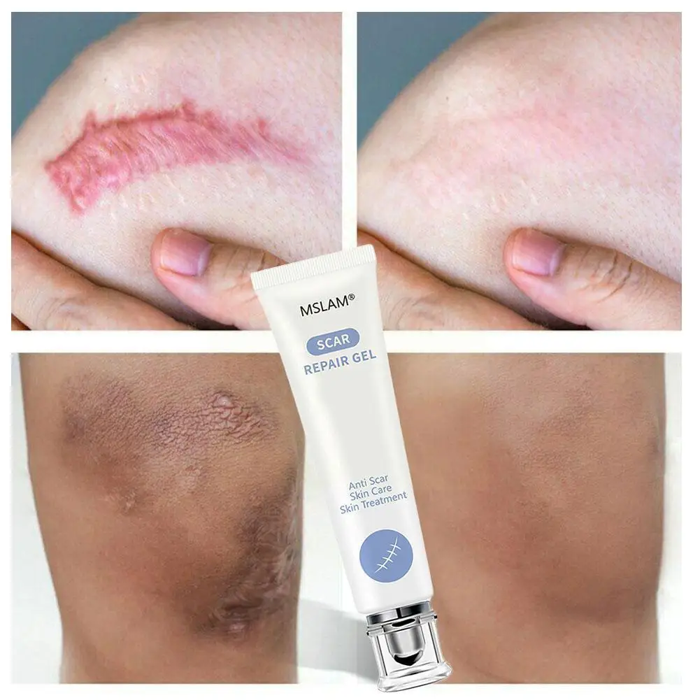 

Scar Repair Gel Removal Scar Acne Cream treatment Marks Corrector Body Pigmentation Skin For Face M0F2
