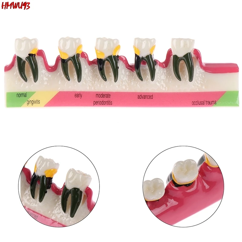 

Dental Lab Periodontal Disease Assort Tooth Typodont Study Teaching Teeth Model Oral Materials