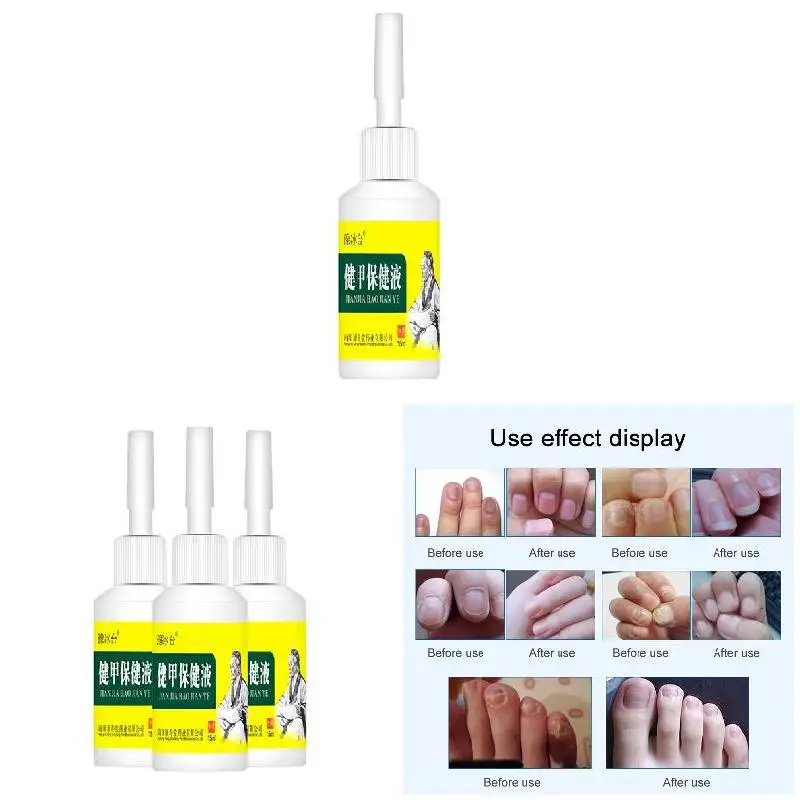

15ml Nail Fungal Treatment Onychomycosis Removal Anti Fungus Nails Care Repair Liquid Nail Care Oil M2