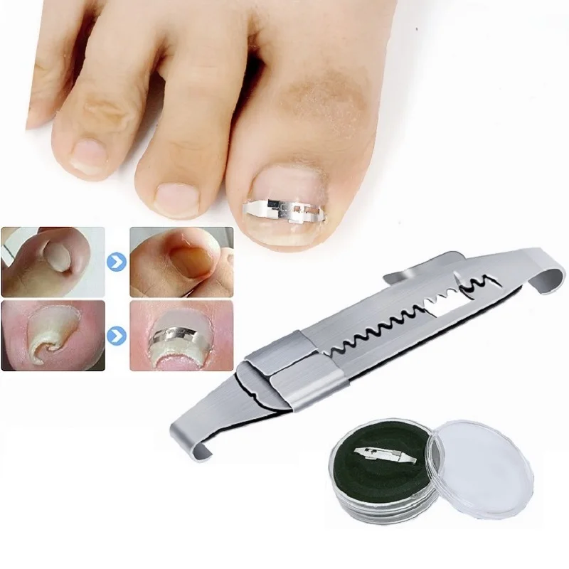 

Ingrown Toenail Pedicure Tools Professional Recover Embed Toe Nail Treatment Paronychia Bunion Hallux Valgus Corrector Foot Care