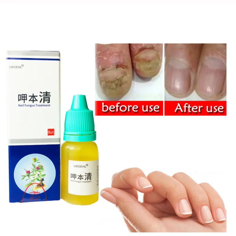 1/2PCS жидкость для лечения онихомикоза паронихии противогрибковые инфекция