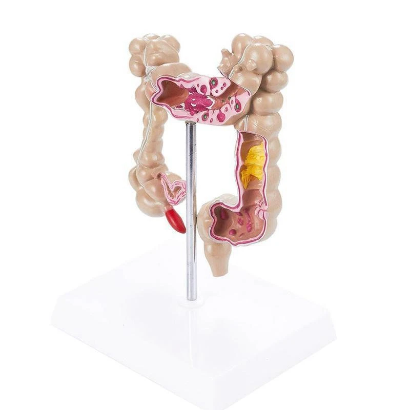 Colorectal Lesion Model Human Colon Large Intestine Pathological Diseases Medical Mrganizer Anatomy |