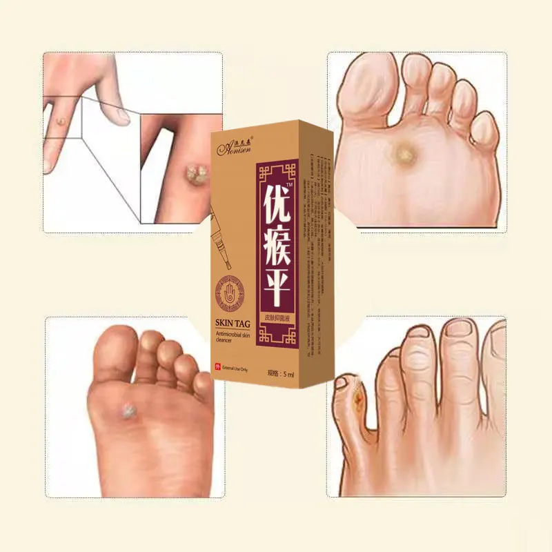 

Skin Tag Remover 12 hours fast Removal Mole & Genital Wart Foot Corn Treatment Kit skin Care Anti Wart Bacterios