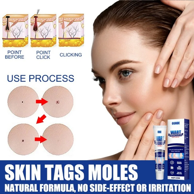 

Warts Remover 20g Chinese Medicine Body Wart Treatment Quyou Corn Ointment Care Clean Skin Body Face Skin Keyou Cream Remover