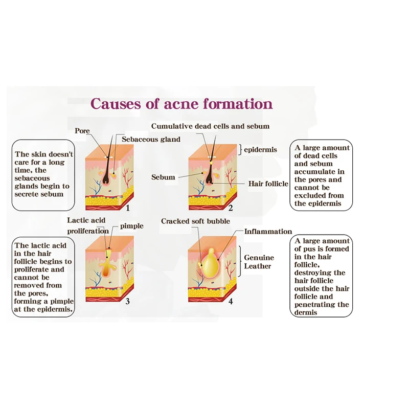 RtopR прополис лечение угрей осветляющая сыворотка акне шрам пятна Очищающая
