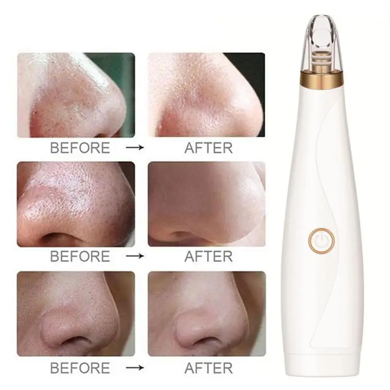 Средство для удаления черных точек лица глубокое удаление пор прыщей акне вакуумное всасывание спа