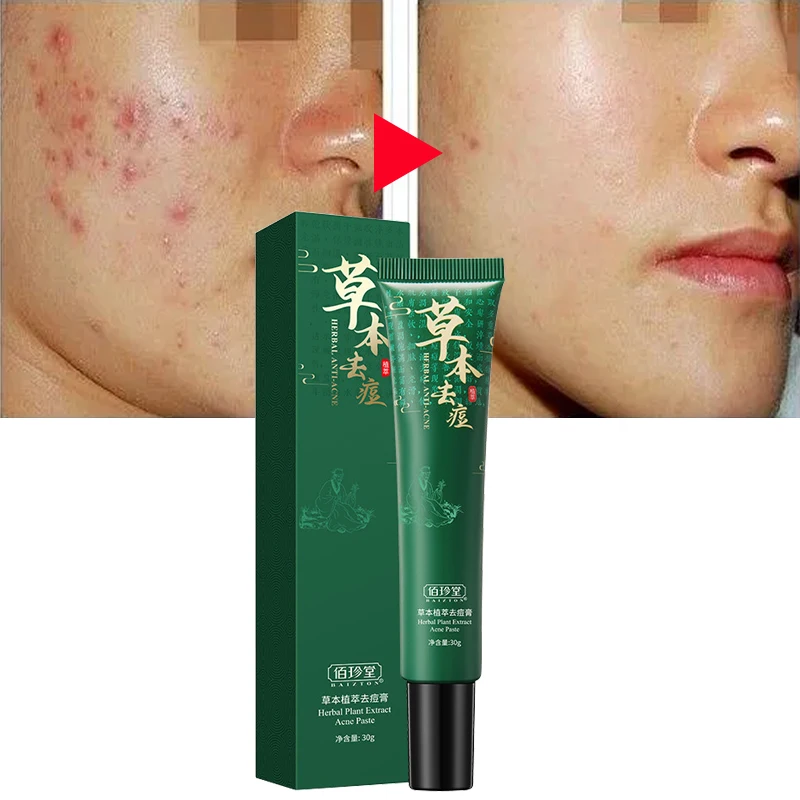 

30G Acne Treatment Face Cream Herbal Plant Extract Anti-acne Repair Fade Acne Spots Oil Control Moisturizing Facial Skin Care