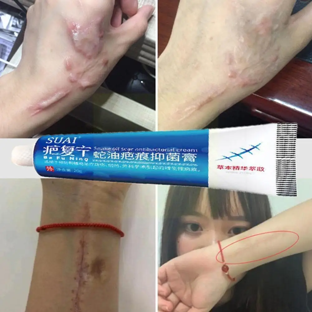 

Acne Scar Removal Cream Pimples Stretch Marks Face Smoothing Acne Care Whitening Gel Remove Moisturizing Body Skin M9t7