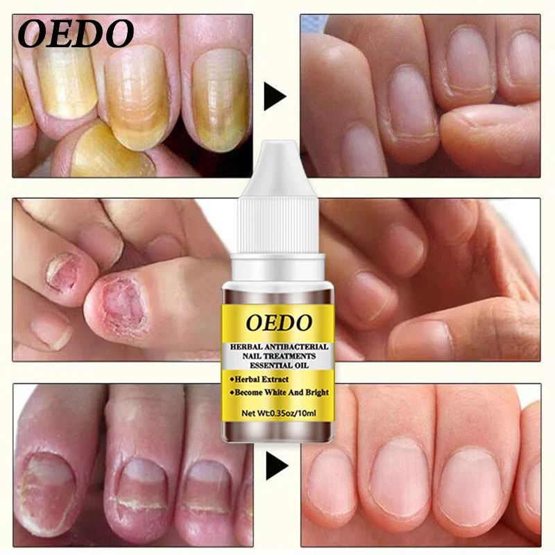 Травяные антигрибковые эфирные масла для лечения Ногтей экстракт китайской