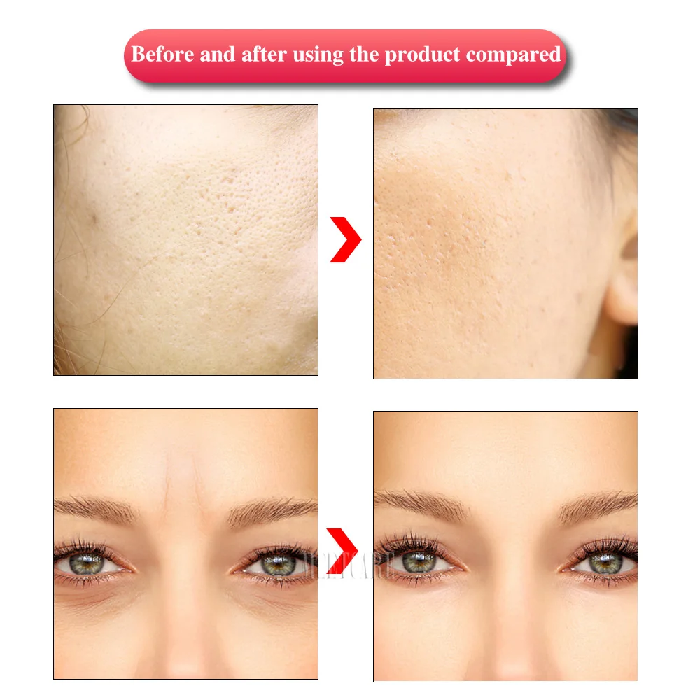 Dr Pen Derma ручка профессиональная Micro Needling отшелушивающая усадочная поры