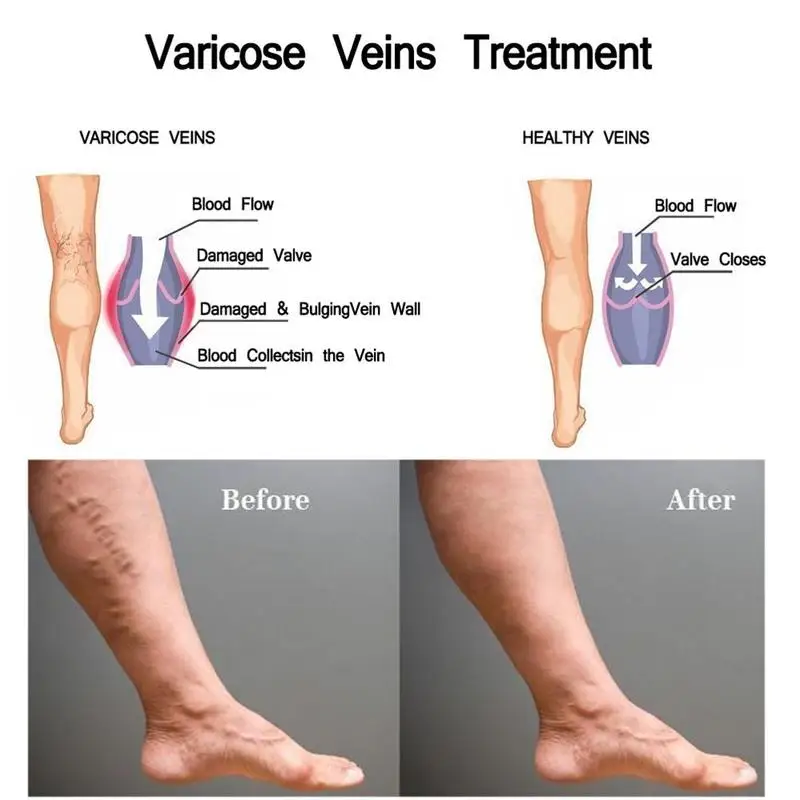 Крем для лечения варикозного расширения вен васкулит флебит Паучья боль