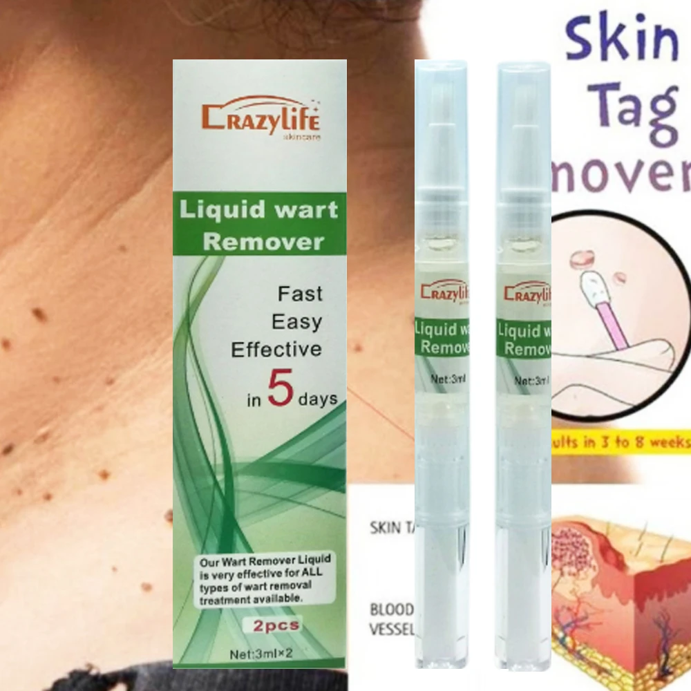 Ручка для удаления шкуры 1 шт. 3 мл|Пластыри терапевтические| |