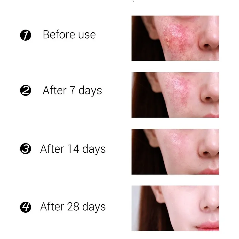 

Acne Treatment Face Cream Anti Acne Scar Removal Pimple Blackhead Moisturizing Oil-control Whiten Shrink Pores Skin Care