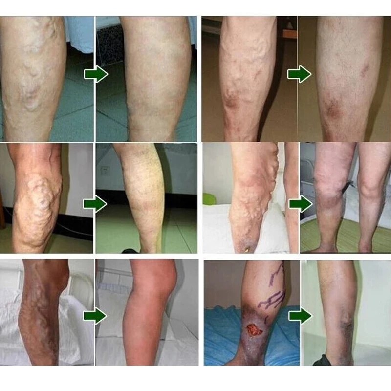 

24 Pcs Spider Veins Varicose Treatment Plaster Varicose Veins Cure Patch Herbal Patches Vasculitis Natural Solution