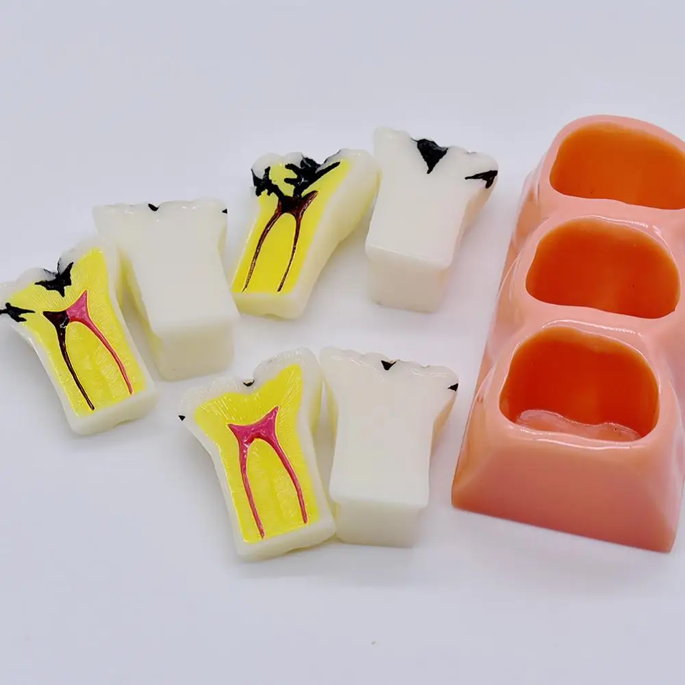 Модель для обучения стоматологии общение пациента модель кариеса разложения