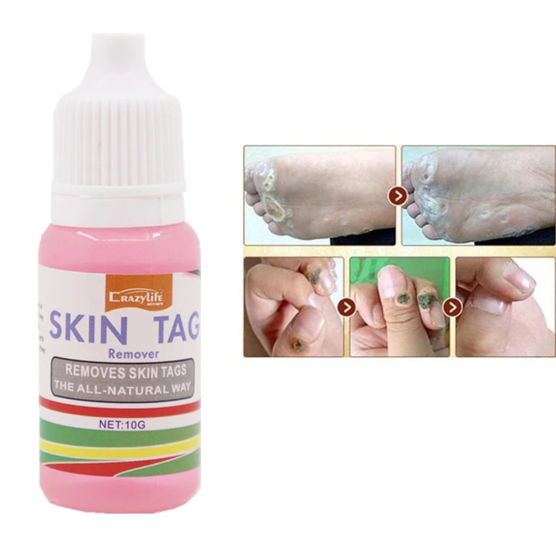 10 мл средство для удаления кожных следов естественное удаление бородавок жидкие