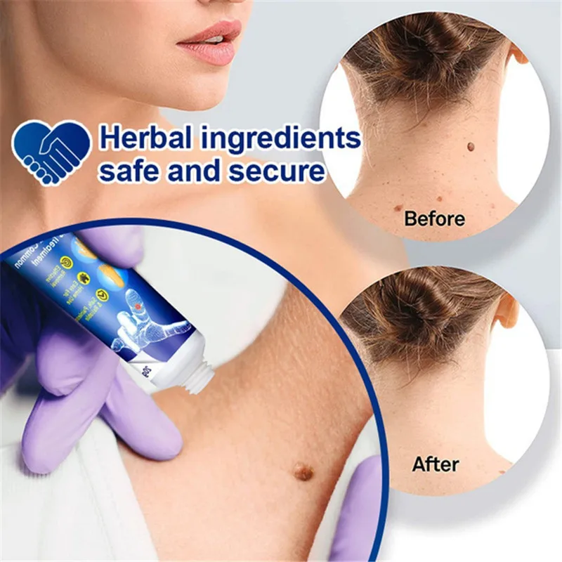 Sumifun Wart Remover Skin Tag Ointment 12 hours Tu kill Medical Mole &ampamp Genital | Красота и здоровье