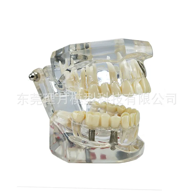 Смоляная съемная модель зубов стоматологическая передвижная патологическая