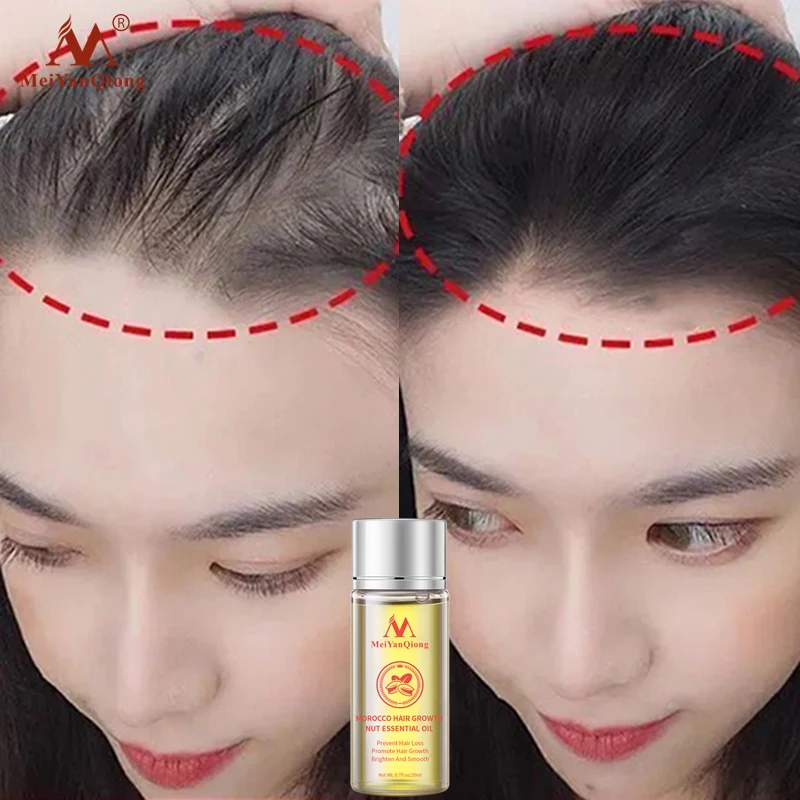 

Марокканская кожа, сыворотка для лечения кожи головы, предотвращение выпадения волос, истончение волос