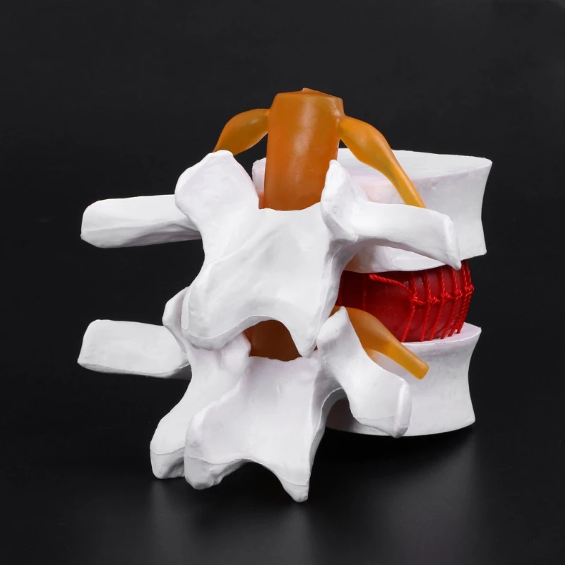 

1 PC White Color Human Lumbar Model Anatomical Lumbar Disc Herniation Model Medical Learn Aid Anatomy Instrume
