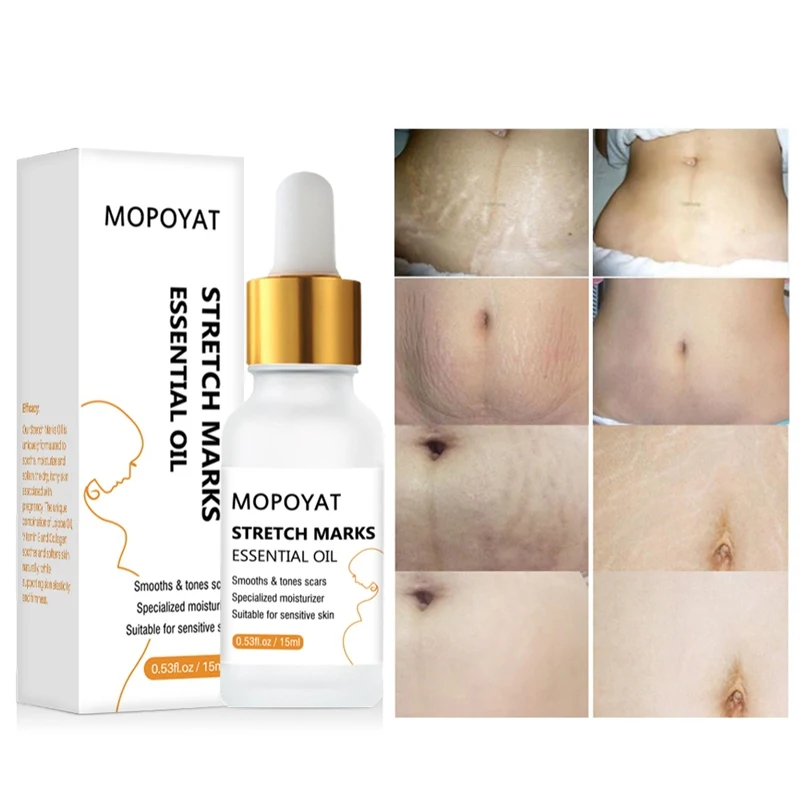 

Stretch Mark Remover Essential Oil Skin Care Treatment Nourishing Whitening Pregnancy Repair Oil 15ml