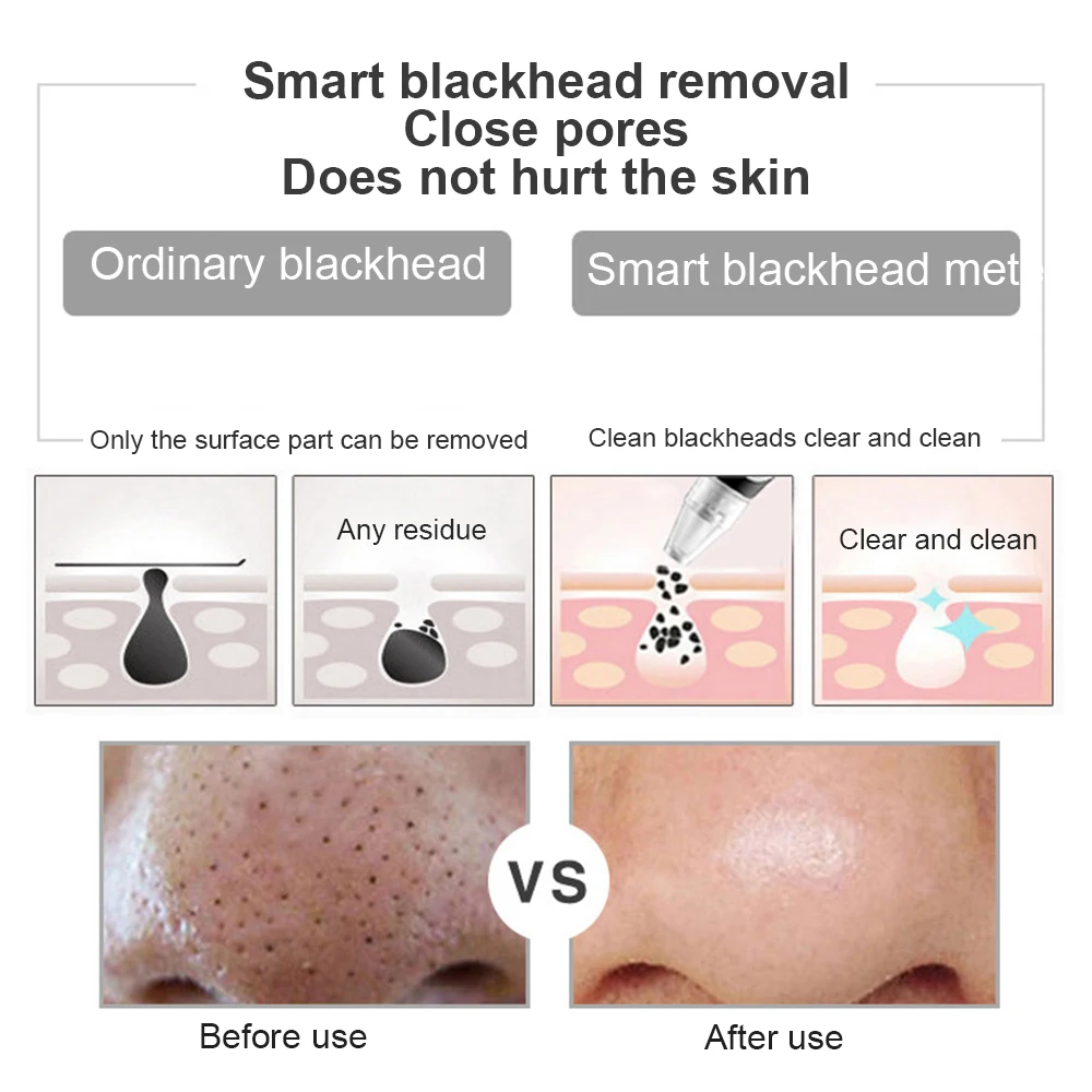 

Electric Pore cleaner blackhead remover vacuum Black heads Acne Pimple Removal Vacuum cleaner black dot Removal Face skin care