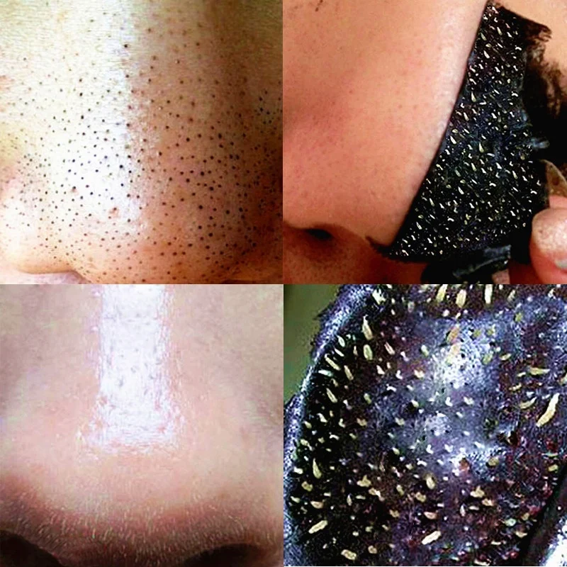 

5bag Mineral Black Mud Blackheads Acne Mask Blackhead Remover Treatment Masks Nose Stickers Cleaner Nose Pore Deep Cleaning Mask