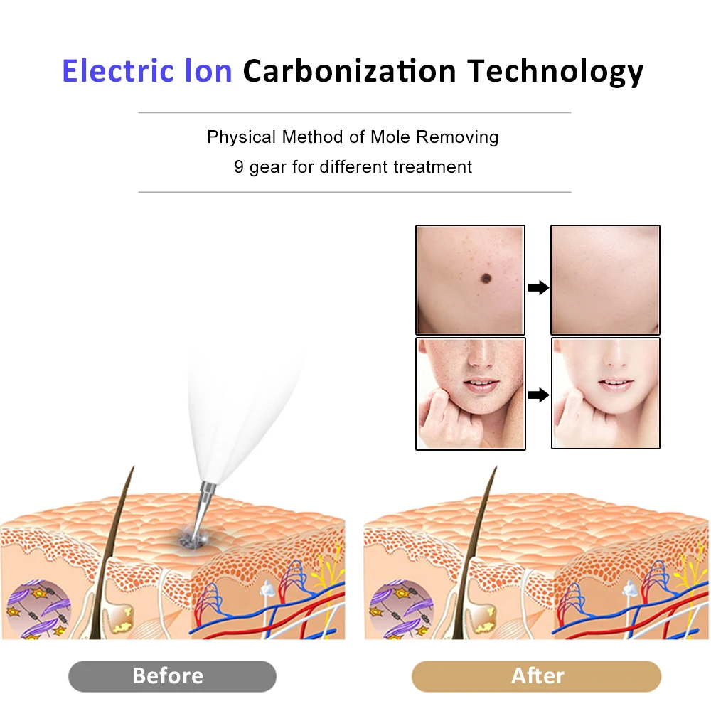 Инструменты для ухода за кожей лазерная веснушка татуировка пятна кожи ручка