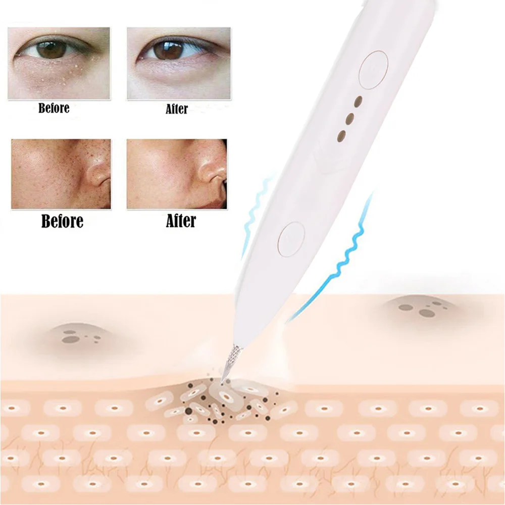 

Plasma Pen Freckle Remove Pen Tattoo Supplies Mole Removal Dark Spot Wart Tag Tattoo Remaval Pen Piercing Needle Skin Care Tool