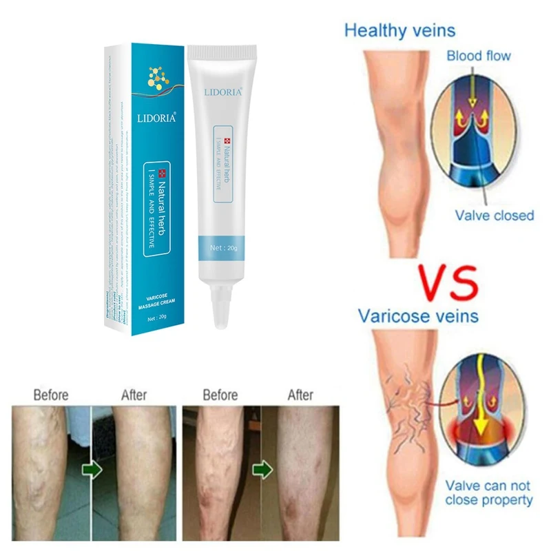 Varicose Veins Cream Promote Blood Circulation Relief Phlebitis Vasculitis Treatment Ointment Vessel Care |