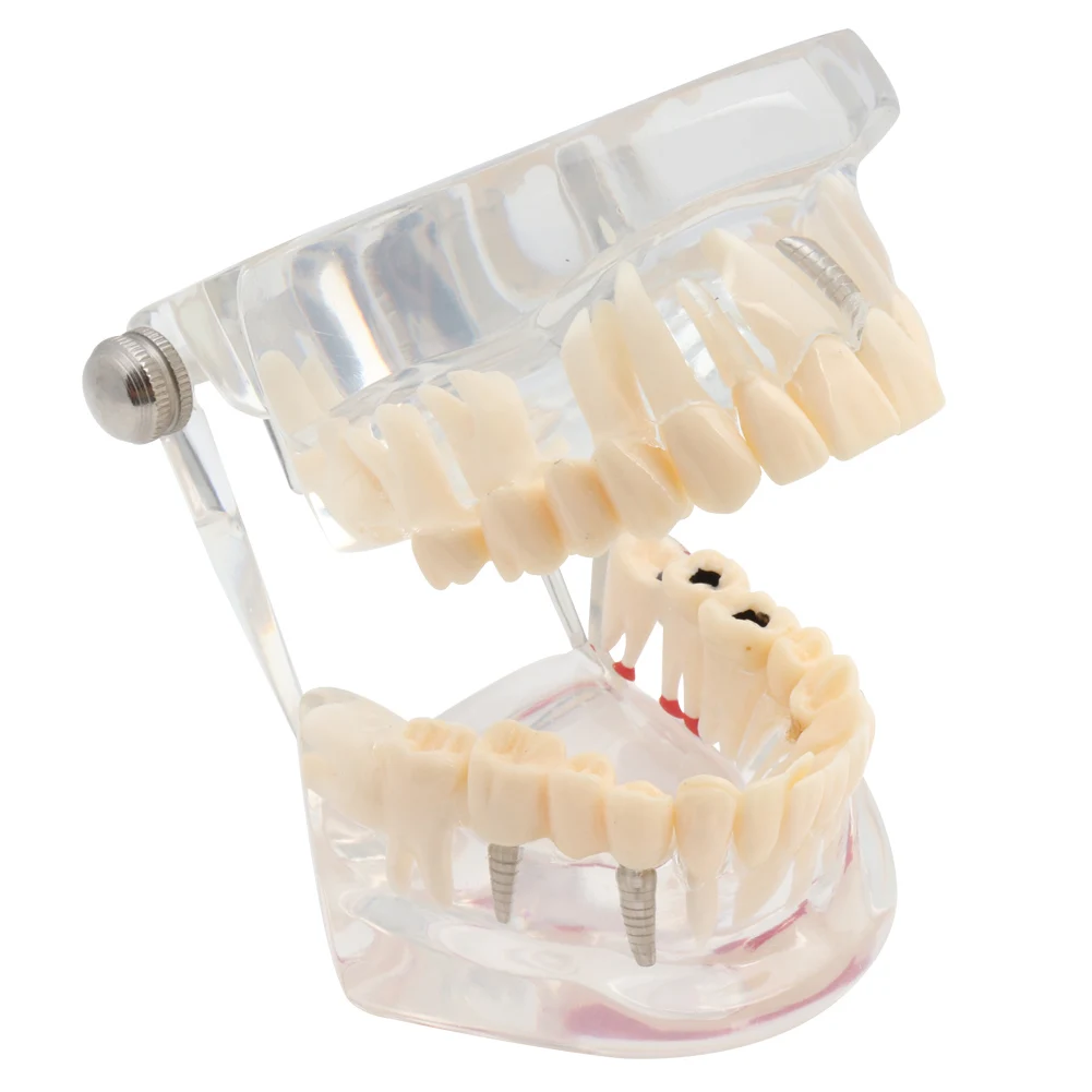 Зубная модель зубов имплантат и реставрация прозрачное исследование