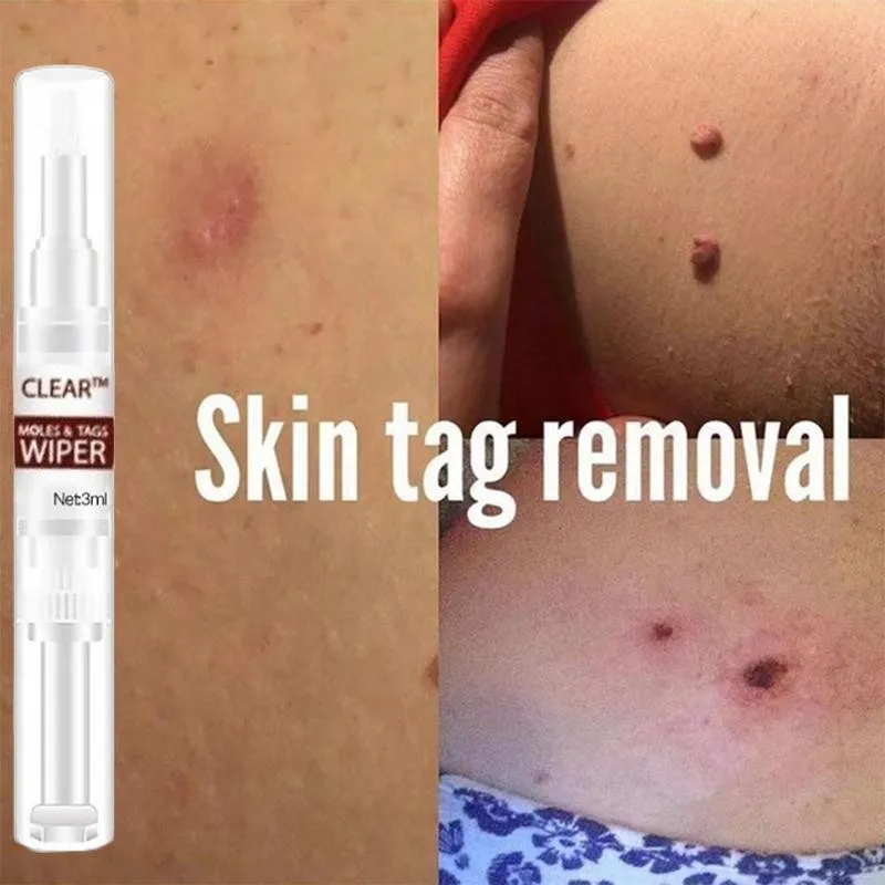 

3ml Genital Wart Treatment Papillomas Removal Off Warts Liquid From Skin Tags Removing Against Moles Remover Anti Verruca Remedy