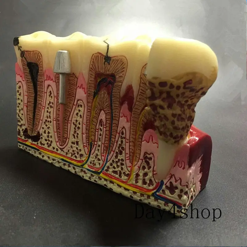 Стоматологическая модель кариеса общая патологий обучения стоматологический