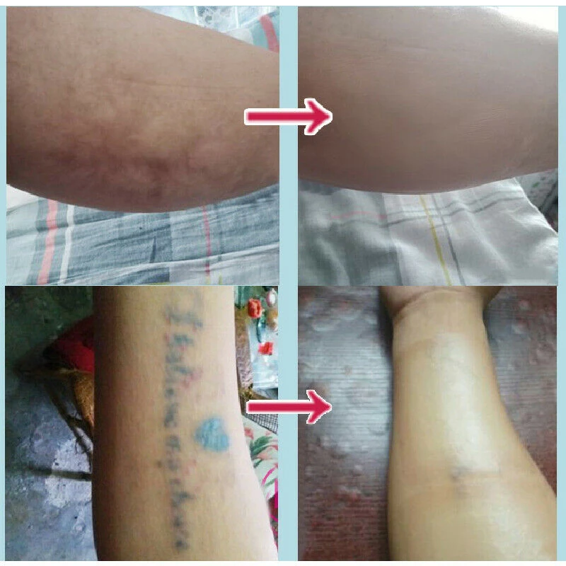 Волшебная Татуировка и дефект шрамов тату шрам маскирующий стикер ленты