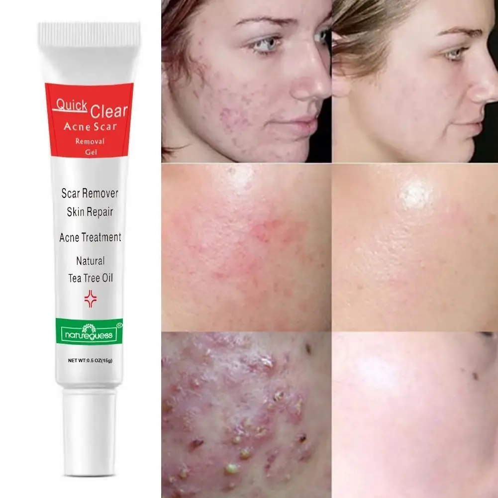 

Treat Acne Scars Remove Blackheads Shrink Pores Oil Gel Care Whitening Repair Cream Control Korean Cosmetics Skin K3X8