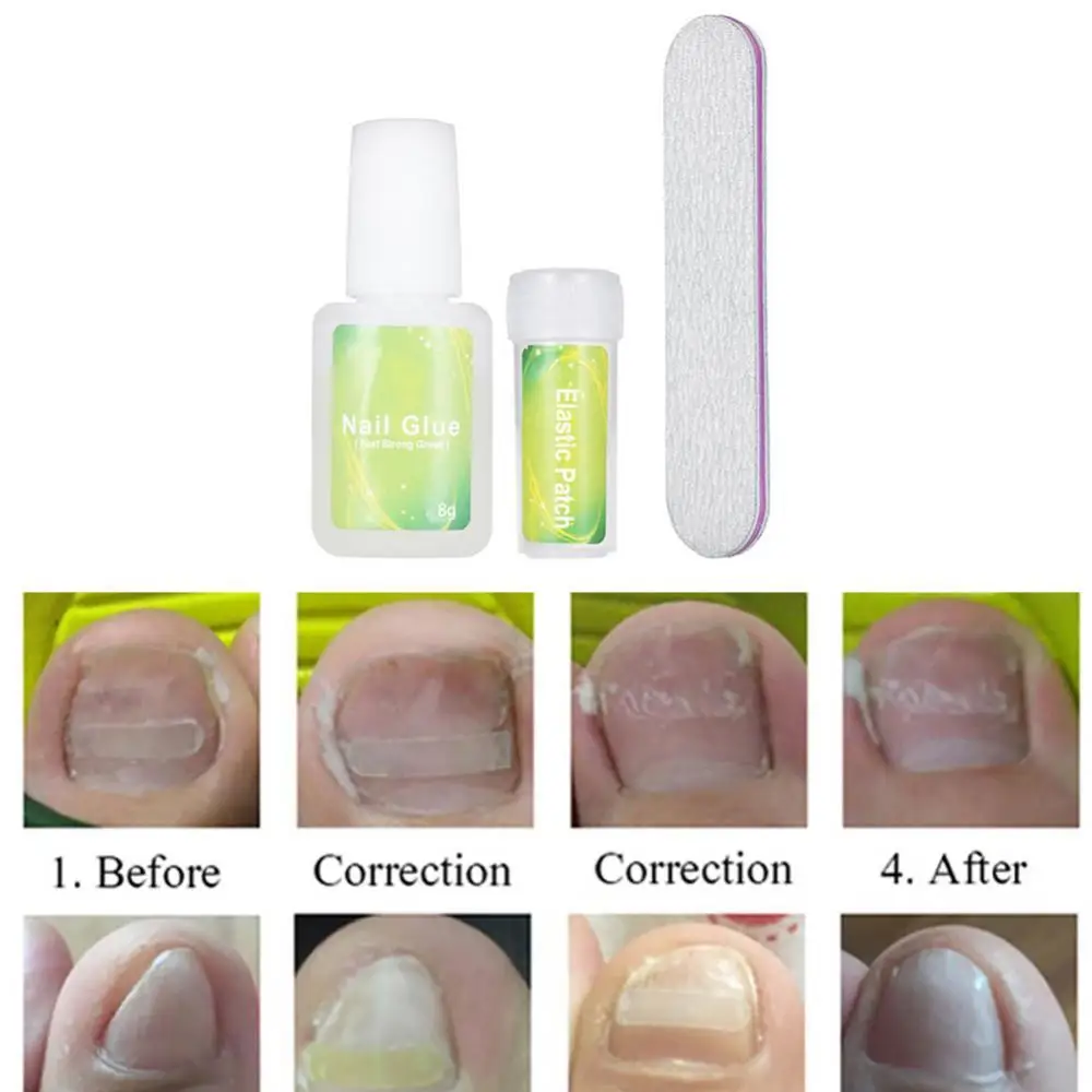 

24/36Pcs Ingrown Toenail Correction Patches Glue Nail File Pedicure Treatment
