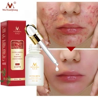 effective acne removal cream acne treatment face serum oil control shrink pores scar essence moisturizer skin care meiyanqiong