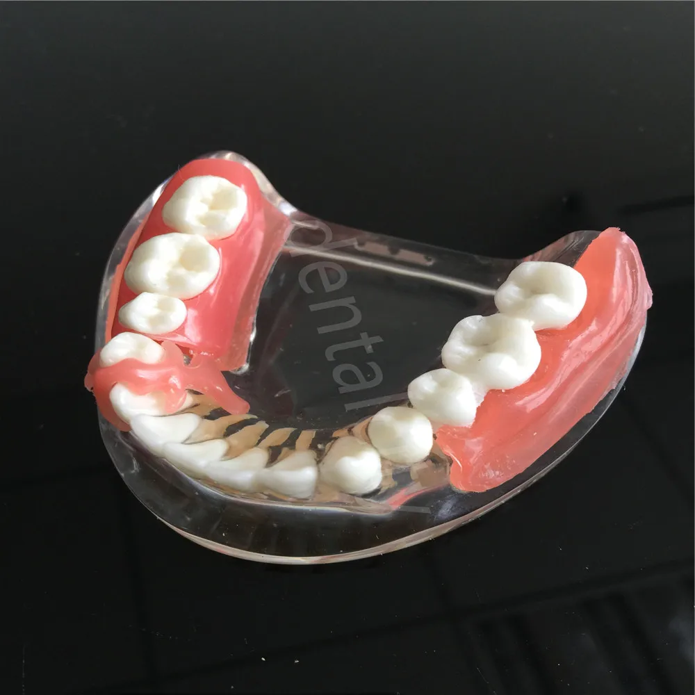 Модель имплантата для зубных протезов с сосудов демонстрация 6006 | Красота и