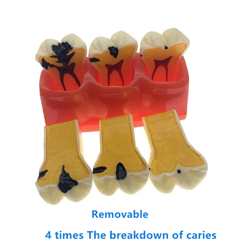 В 4 раза кариеса Comparation модели зубов Модель обучения научно исследовательских