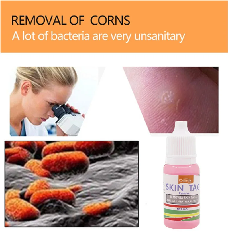 

CrazyLife Skin Tag Cure Removal Liquid Corn Body Mole Wart Remover Spot Marks Treatment Painless Body Care Skin Care