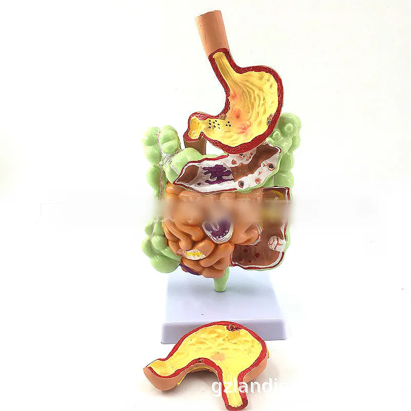 

Pathological model of large intestine stomach model of large intestine disease model of human colon disease