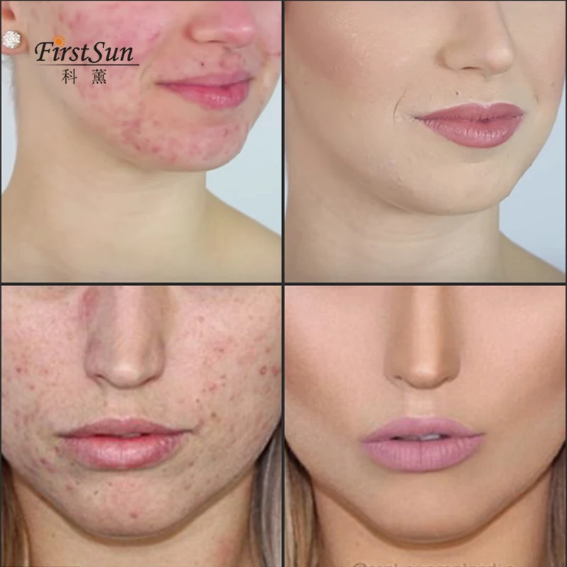 Эфирные масла чайного дерева увлажняющее растительное масло для контроля