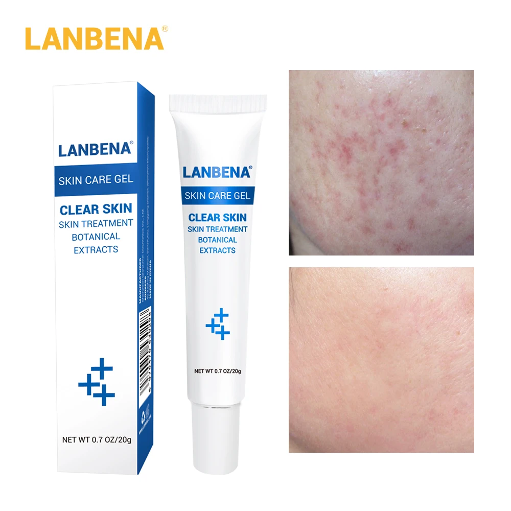Acne Cream LANBENA маска для лица, лечение акне, маска для лица, уход за кожей, средство для удаления прыщей, патчи, наклейки, черная маска, пилинг, маски для лица - Цвет: Acne Cream
