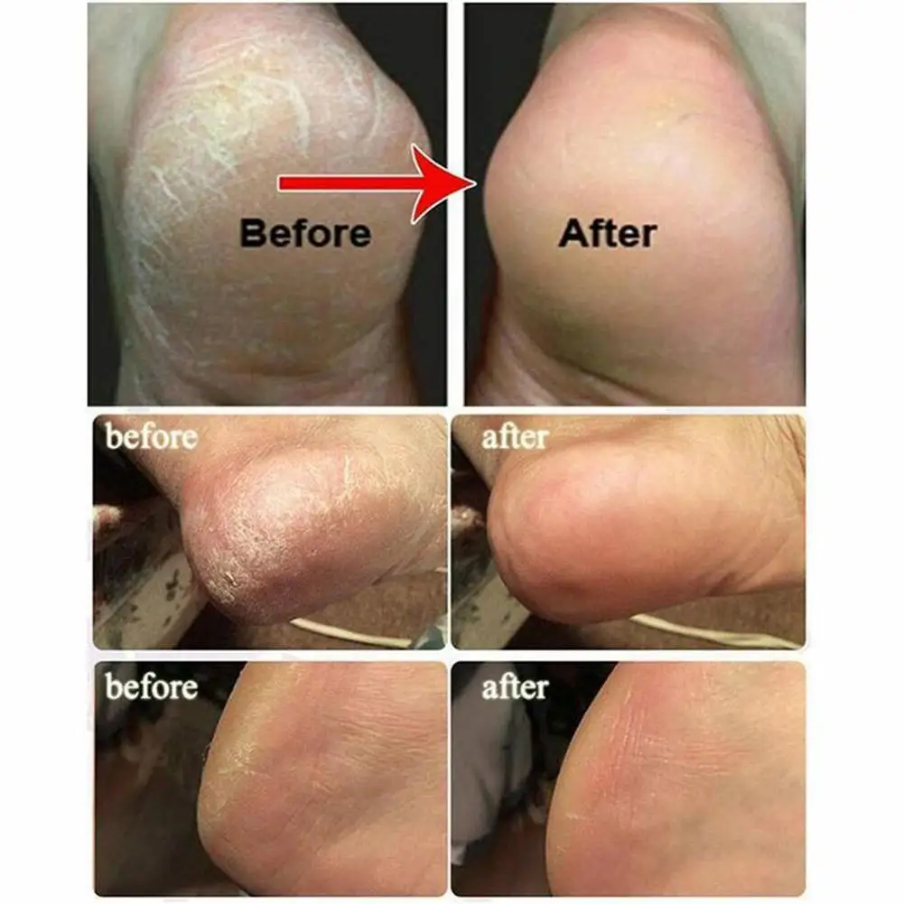 

10 pieces of foot bath and foot bath tablets set Chinese foot tablets medicine fatigue to relieve effervescent care dead re F4T0