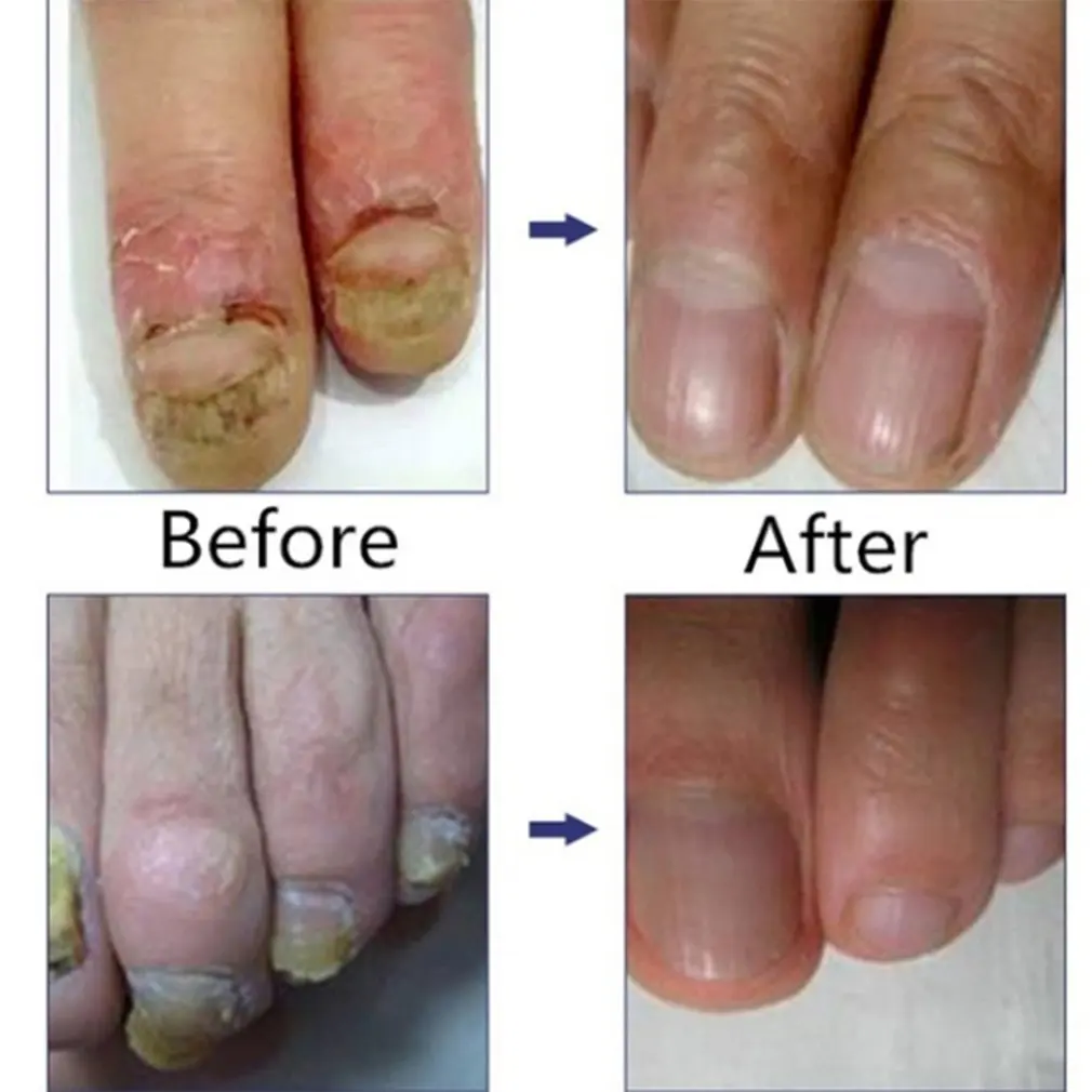 10 мл натуральный Уход за ногтями уход здоровой кожей для ухода лечение жидкое